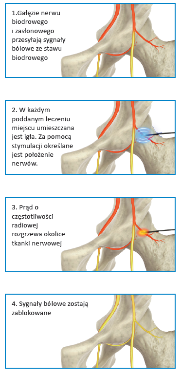 leczenie bolu biodra cosman