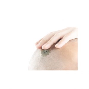 Cranial Cover – system zakrycia otworów potrepanacyjnych